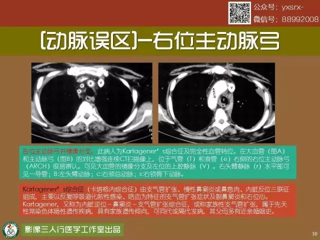 【PPT】纵隔内血管变异与CT诊断误区 【PPT】纵隔内血管变异与CT诊断误区