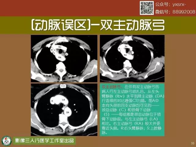 【PPT】纵隔内血管变异与CT诊断误区 【PPT】纵隔内血管变异与CT诊断误区