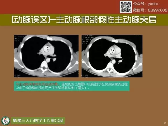 【PPT】纵隔内血管变异与CT诊断误区 【PPT】纵隔内血管变异与CT诊断误区