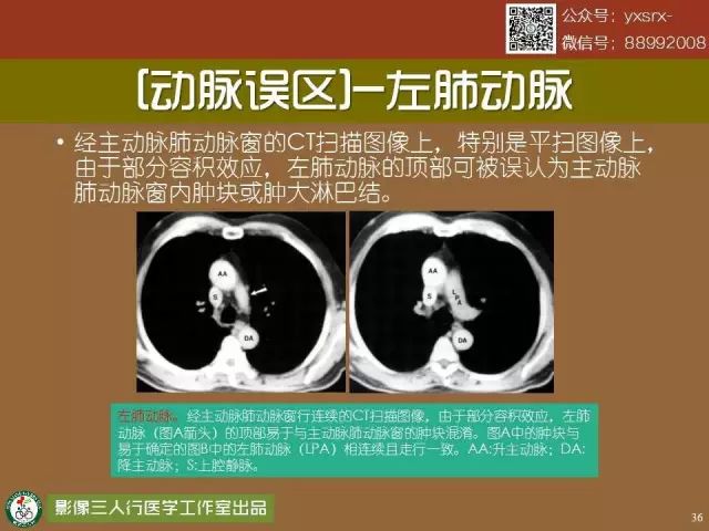 【PPT】纵隔内血管变异与CT诊断误区 【PPT】纵隔内血管变异与CT诊断误区
