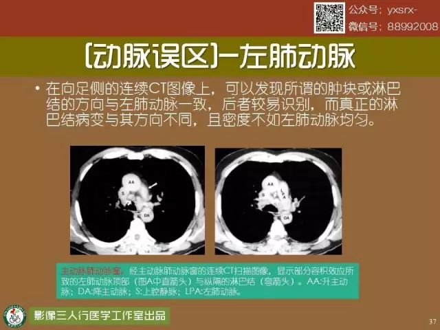 【PPT】纵隔内血管变异与CT诊断误区 【PPT】纵隔内血管变异与CT诊断误区