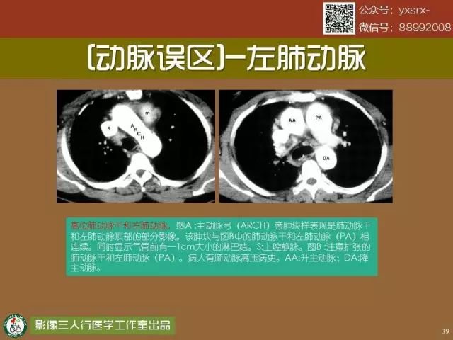 【PPT】纵隔内血管变异与CT诊断误区 【PPT】纵隔内血管变异与CT诊断误区