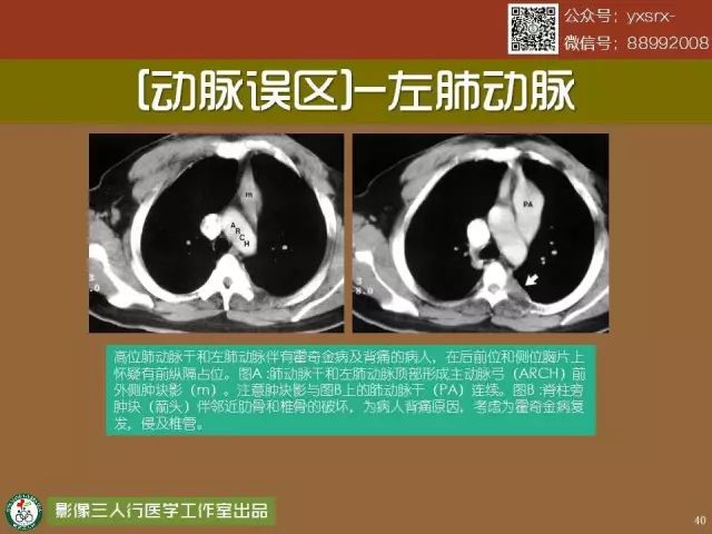 【PPT】纵隔内血管变异与CT诊断误区 【PPT】纵隔内血管变异与CT诊断误区