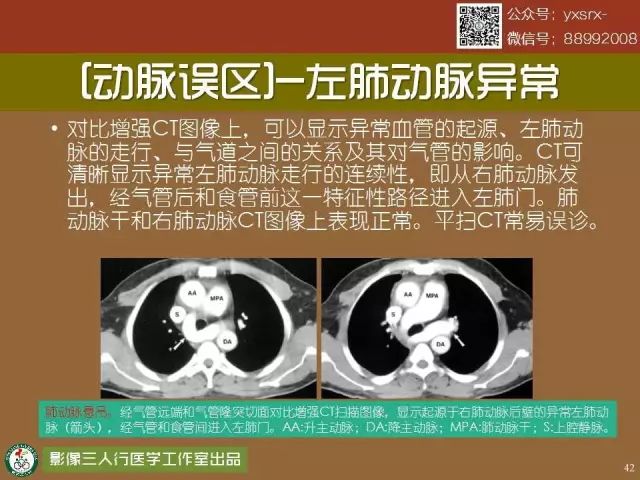 【PPT】纵隔内血管变异与CT诊断误区 【PPT】纵隔内血管变异与CT诊断误区