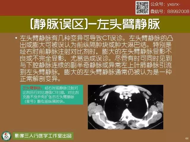 【PPT】纵隔内血管变异与CT诊断误区 【PPT】纵隔内血管变异与CT诊断误区