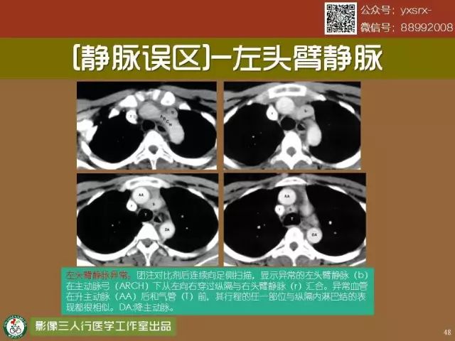 【PPT】纵隔内血管变异与CT诊断误区 【PPT】纵隔内血管变异与CT诊断误区