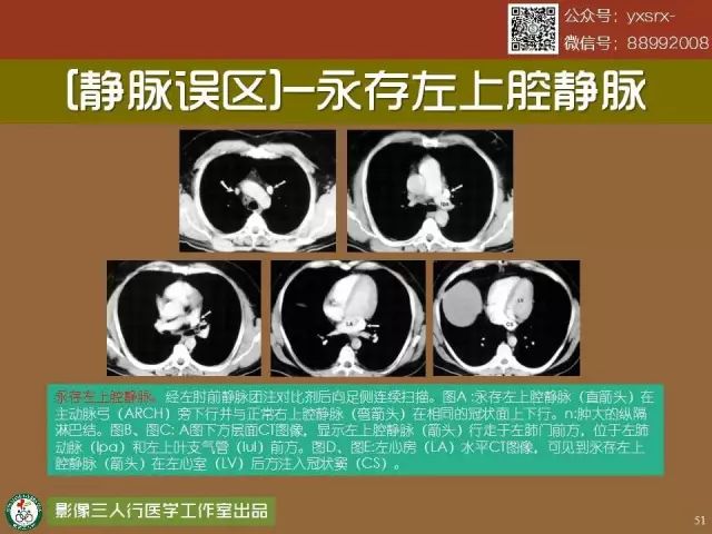【PPT】纵隔内血管变异与CT诊断误区 【PPT】纵隔内血管变异与CT诊断误区
