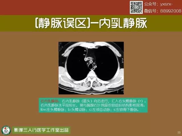 【PPT】纵隔内血管变异与CT诊断误区 【PPT】纵隔内血管变异与CT诊断误区