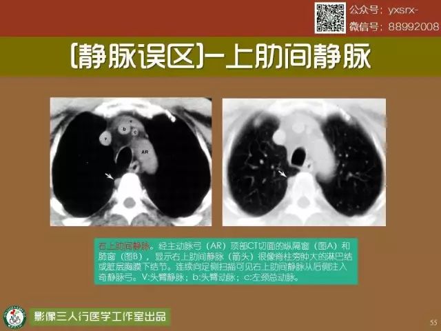 【PPT】纵隔内血管变异与CT诊断误区 【PPT】纵隔内血管变异与CT诊断误区