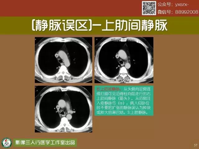 【PPT】纵隔内血管变异与CT诊断误区 【PPT】纵隔内血管变异与CT诊断误区