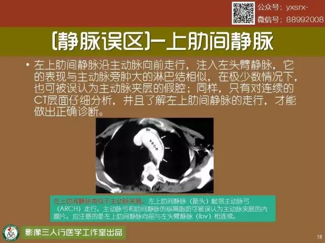【PPT】纵隔内血管变异与CT诊断误区 【PPT】纵隔内血管变异与CT诊断误区