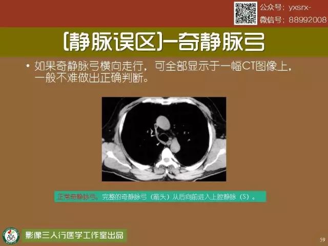 【PPT】纵隔内血管变异与CT诊断误区 【PPT】纵隔内血管变异与CT诊断误区