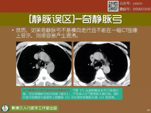 【PPT】纵隔内血管变异与CT诊断误区 【PPT】纵隔内血管变异与CT诊断误区