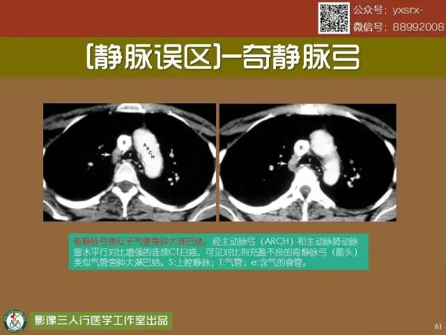 【PPT】纵隔内血管变异与CT诊断误区 【PPT】纵隔内血管变异与CT诊断误区