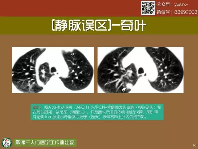 【PPT】纵隔内血管变异与CT诊断误区 【PPT】纵隔内血管变异与CT诊断误区