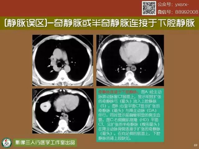 【PPT】纵隔内血管变异与CT诊断误区 【PPT】纵隔内血管变异与CT诊断误区