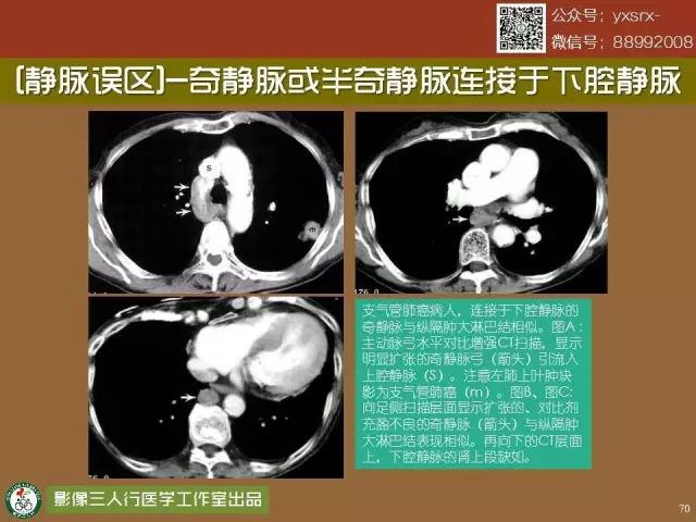 【PPT】纵隔内血管变异与CT诊断误区 【PPT】纵隔内血管变异与CT诊断误区