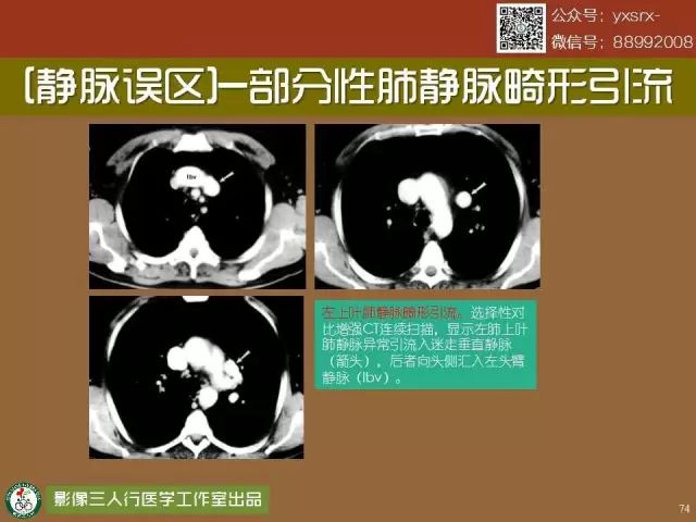 【PPT】纵隔内血管变异与CT诊断误区 【PPT】纵隔内血管变异与CT诊断误区