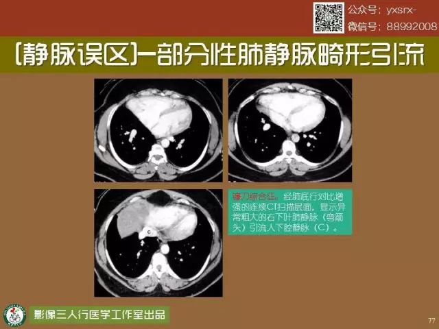 【PPT】纵隔内血管变异与CT诊断误区 【PPT】纵隔内血管变异与CT诊断误区