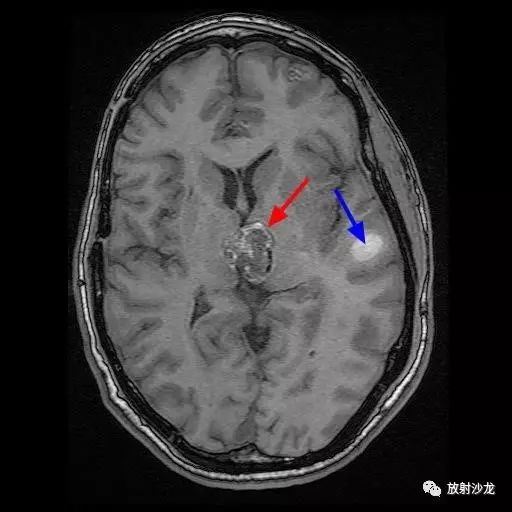 【病例】脑内多发海绵状血管瘤1例 【病例】脑内多发海绵状血管瘤1例