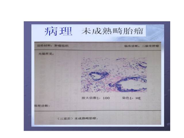 【病例】第三脑室后部未成熟畸胎瘤一例MR