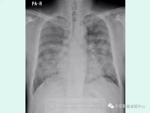 【病例】肺泡蛋白沉积症1例CT影像表现