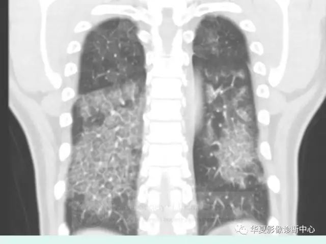 【病例】肺泡蛋白沉积症1例CT影像表现