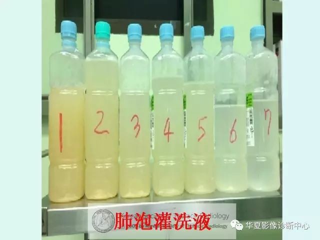 【病例】肺泡蛋白沉积症1例CT影像表现