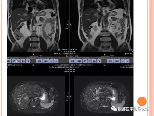 【病例】肝脏孤立性坏死结节SNN一例MR影像表现 【病例】肝脏孤立性坏死结节SNN一例MR影像表现