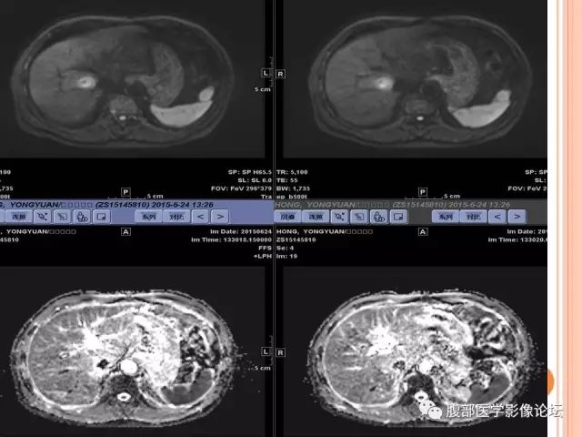 【病例】肝脏孤立性坏死结节SNN一例MR影像表现