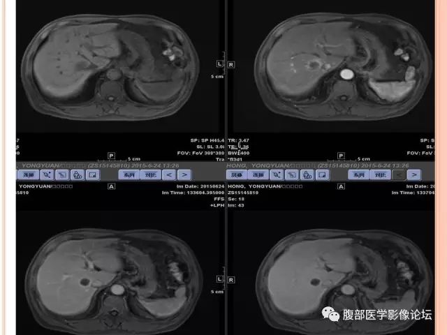 【病例】肝脏孤立性坏死结节SNN一例MR影像表现 【病例】肝脏孤立性坏死结节SNN一例MR影像表现