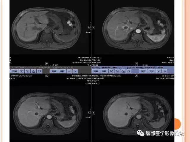 【病例】肝脏孤立性坏死结节SNN一例MR影像表现 【病例】肝脏孤立性坏死结节SNN一例MR影像表现