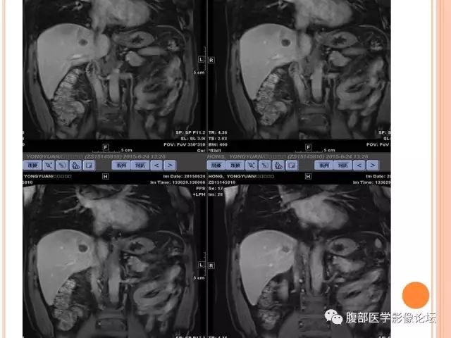 【病例】肝脏孤立性坏死结节SNN一例MR影像表现 【病例】肝脏孤立性坏死结节SNN一例MR影像表现