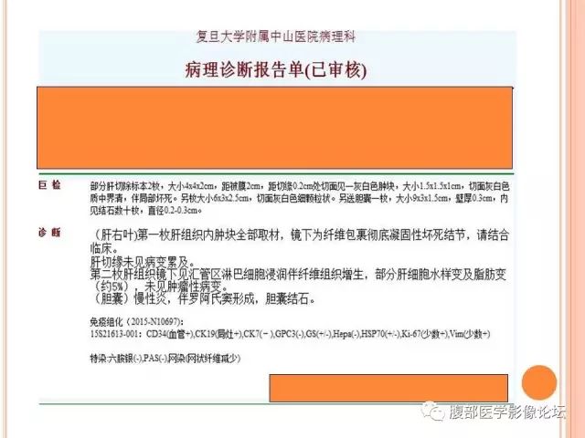 【病例】肝脏孤立性坏死结节SNN一例MR影像表现 【病例】肝脏孤立性坏死结节SNN一例MR影像表现