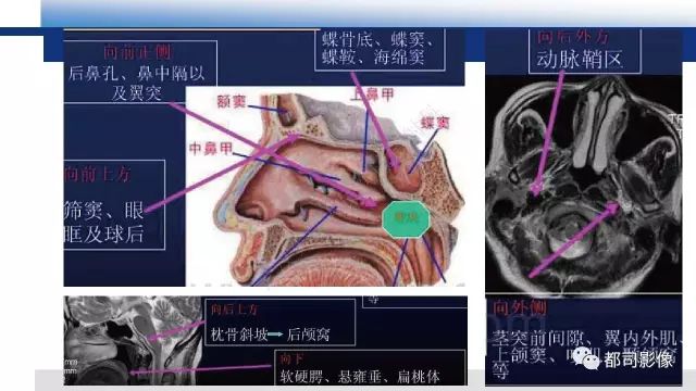 【PPT】鼻咽肿瘤性病变影像诊断