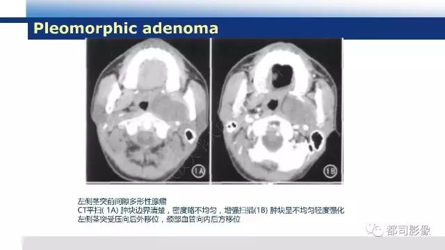 【PPT】鼻咽肿瘤性病变影像诊断
