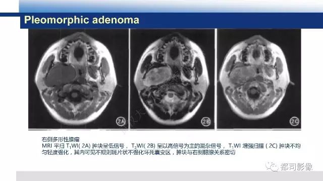 【PPT】鼻咽肿瘤性病变影像诊断