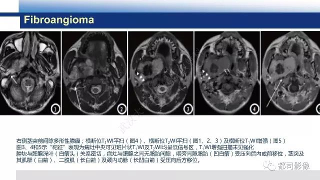 【PPT】鼻咽肿瘤性病变影像诊断