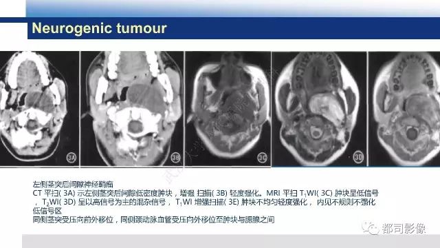 【PPT】鼻咽肿瘤性病变影像诊断