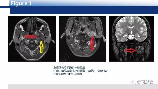【PPT】鼻咽肿瘤性病变影像诊断