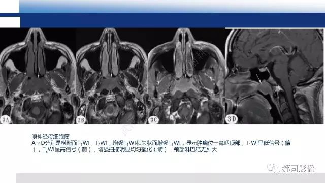 【PPT】鼻咽肿瘤性病变影像诊断