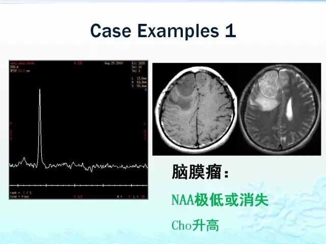【PPT】MRS在颅脑疾病中的应用