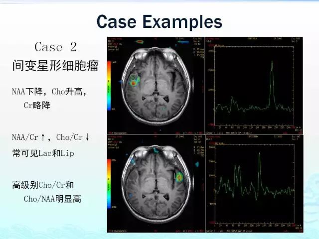 【PPT】MRS在颅脑疾病中的应用