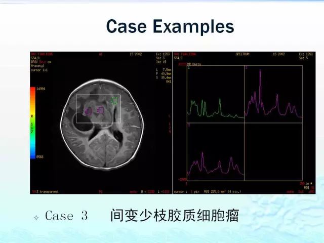 【PPT】MRS在颅脑疾病中的应用