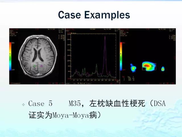【PPT】MRS在颅脑疾病中的应用