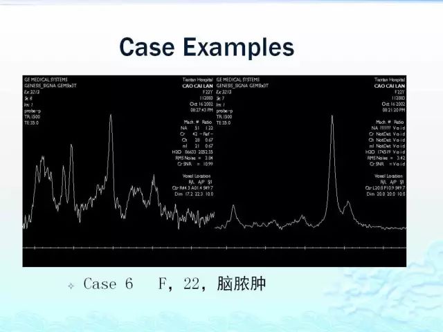 【PPT】MRS在颅脑疾病中的应用