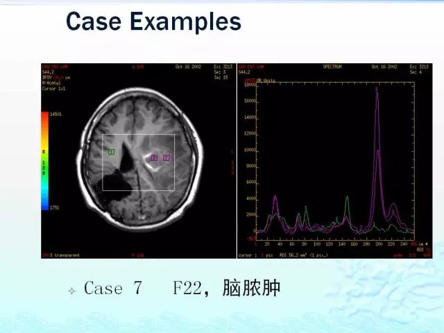 【PPT】MRS在颅脑疾病中的应用