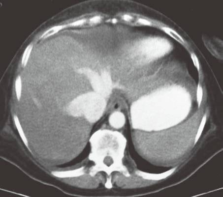 4类“肝脏密度弥漫性减低”的疾病 4类“肝脏密度弥漫性减低”的疾病