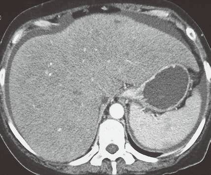 4类“肝脏密度弥漫性减低”的疾病 4类“肝脏密度弥漫性减低”的疾病