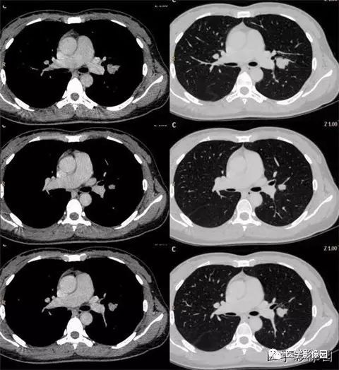【病例】肺硬化性血管瘤1例CT 【病例】肺硬化性血管瘤1例CT